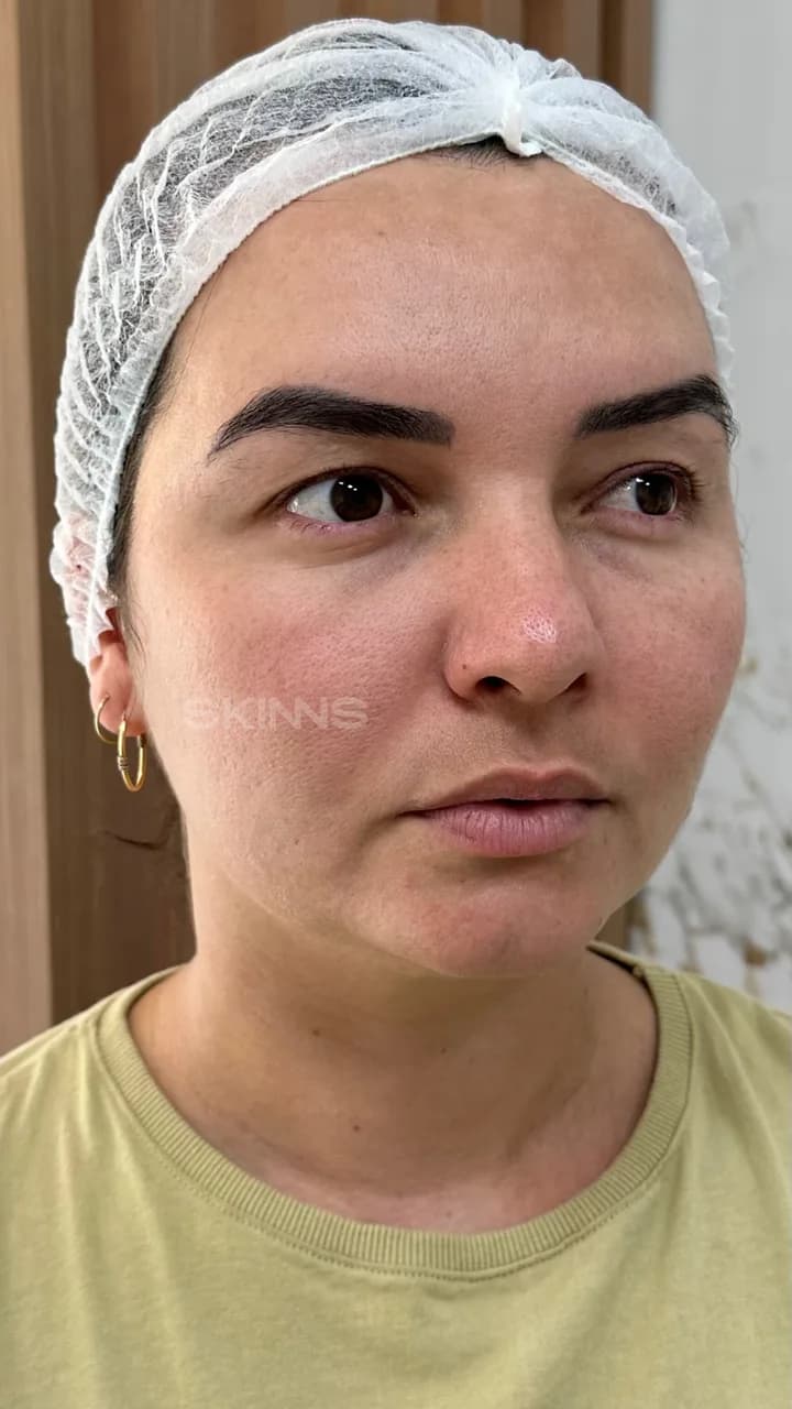 Depois — Skims Melani