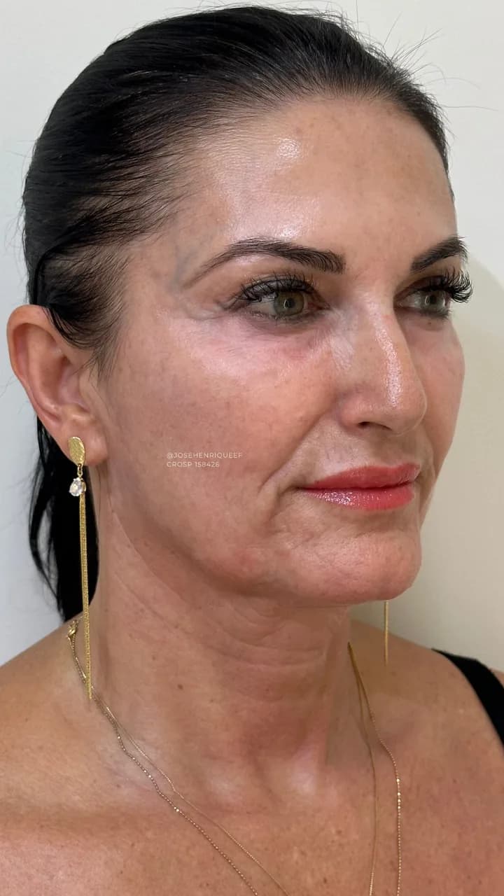 Depois — Skims Rejuvenescimento