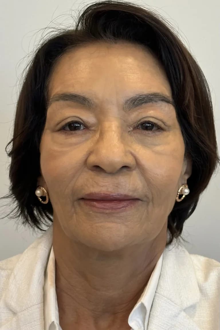 Depois — Peeling, paciente Eliete Mendes