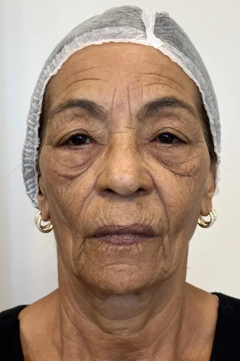 Antes — Peeling, paciente Eliete Mendes