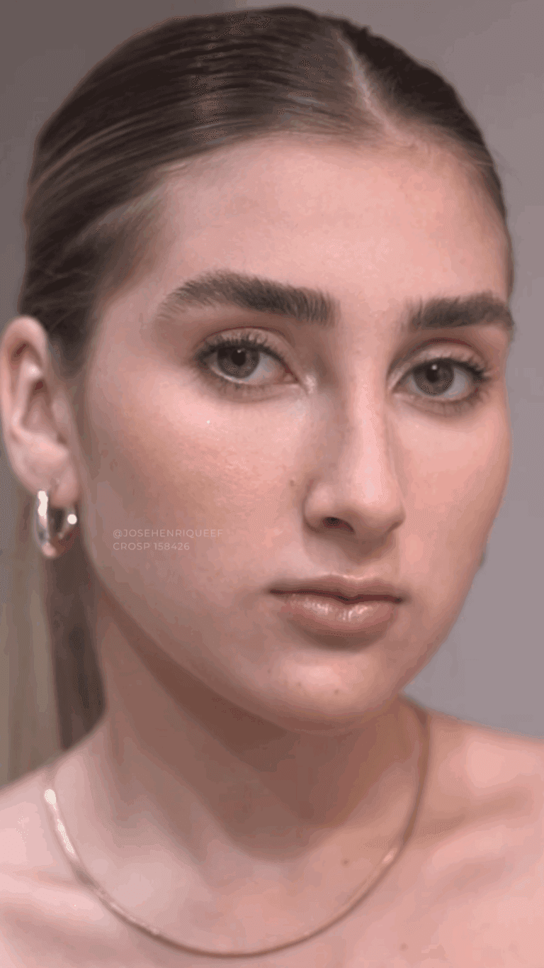 Depois — Natural Beauty, paciente Estéfany Corteleti