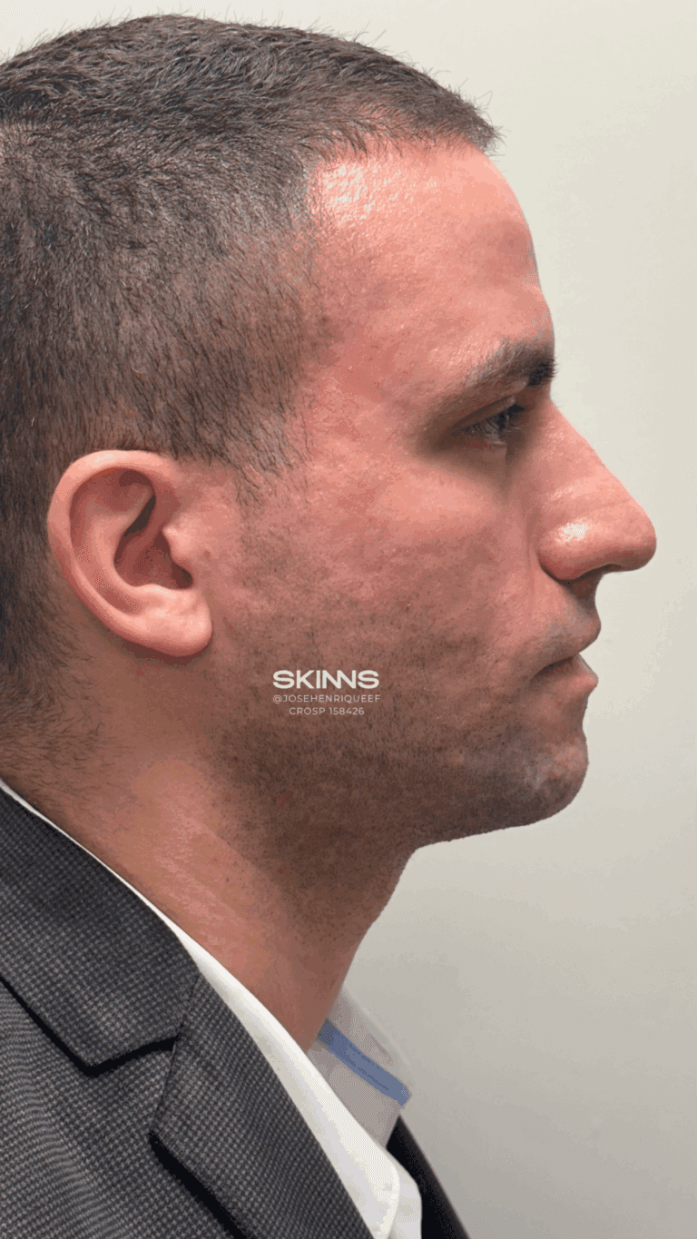Depois — Peeling, paciente Ciro Gonçalves
