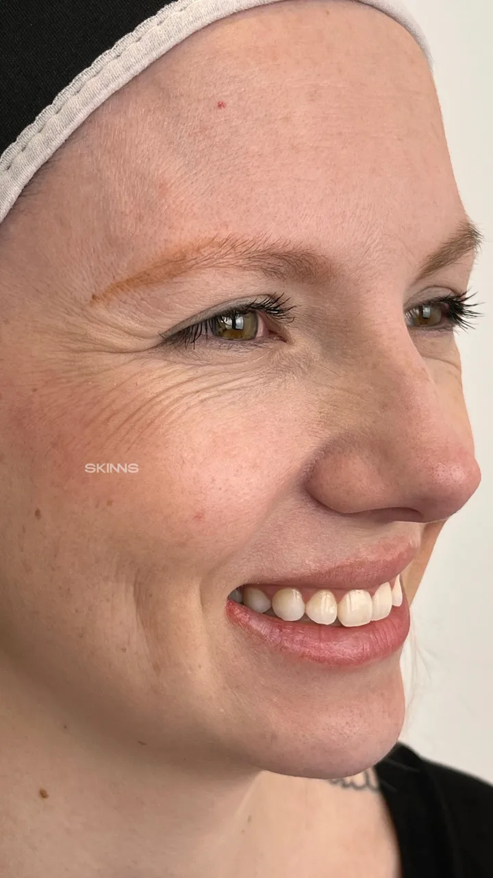 Before — Blefaropeel