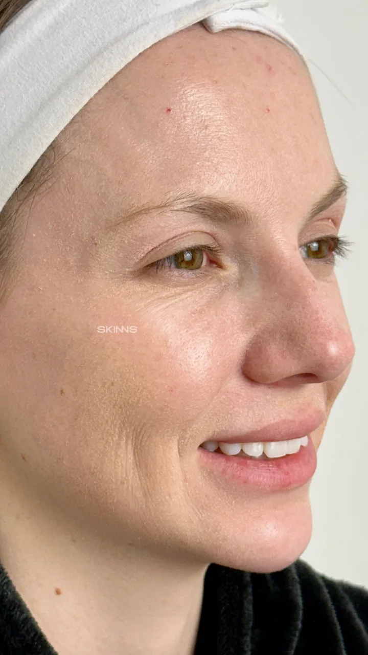 After — Blefaropeel