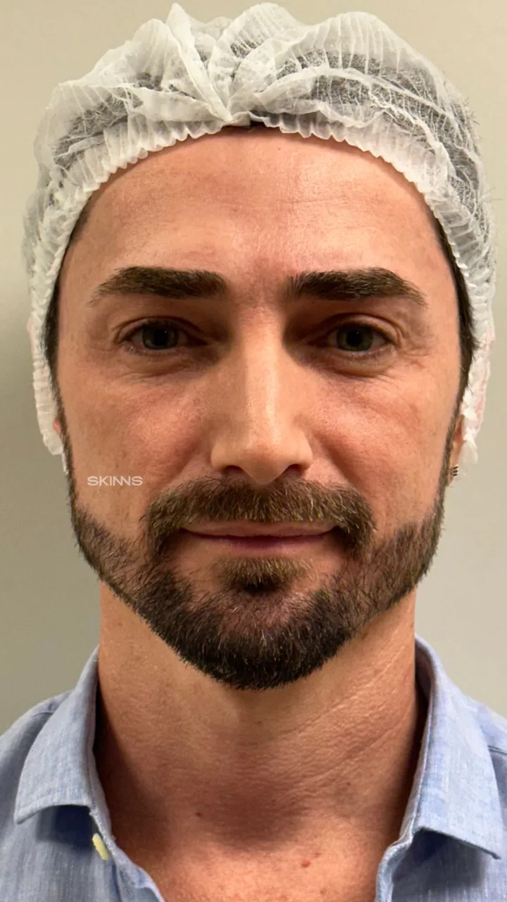 Antes — Blefaropeel