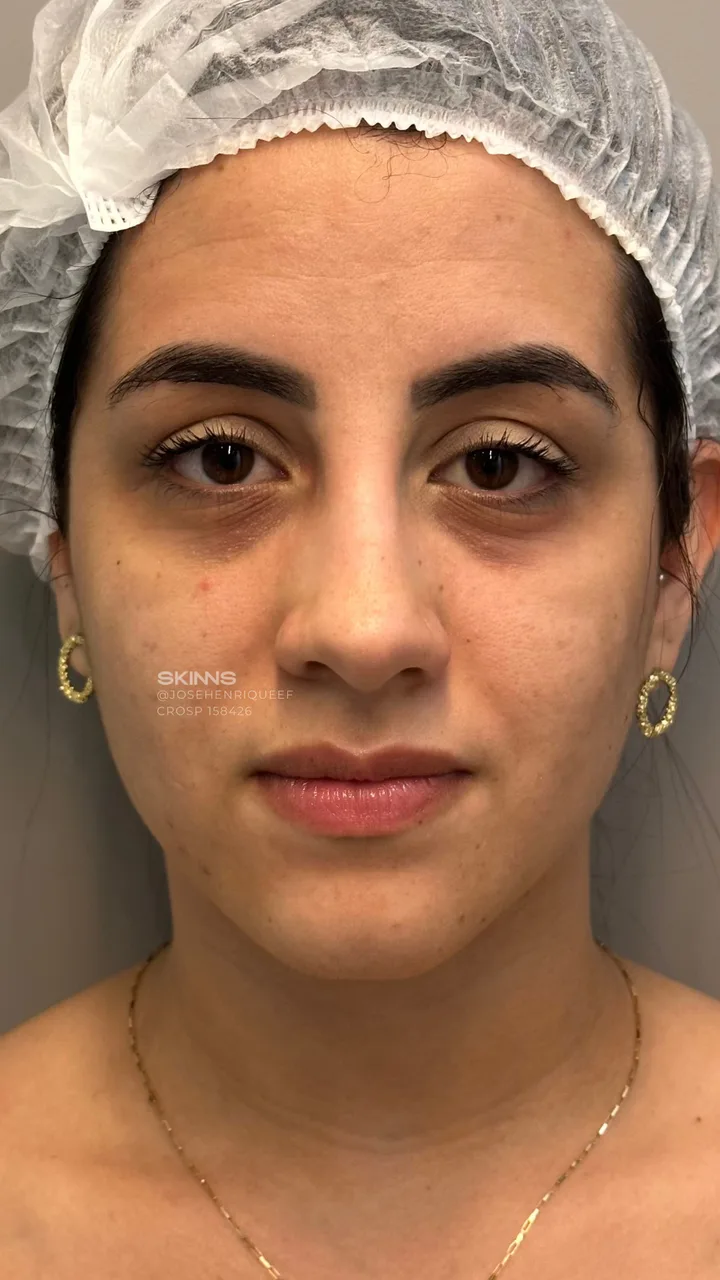 Before — Blefaropeel