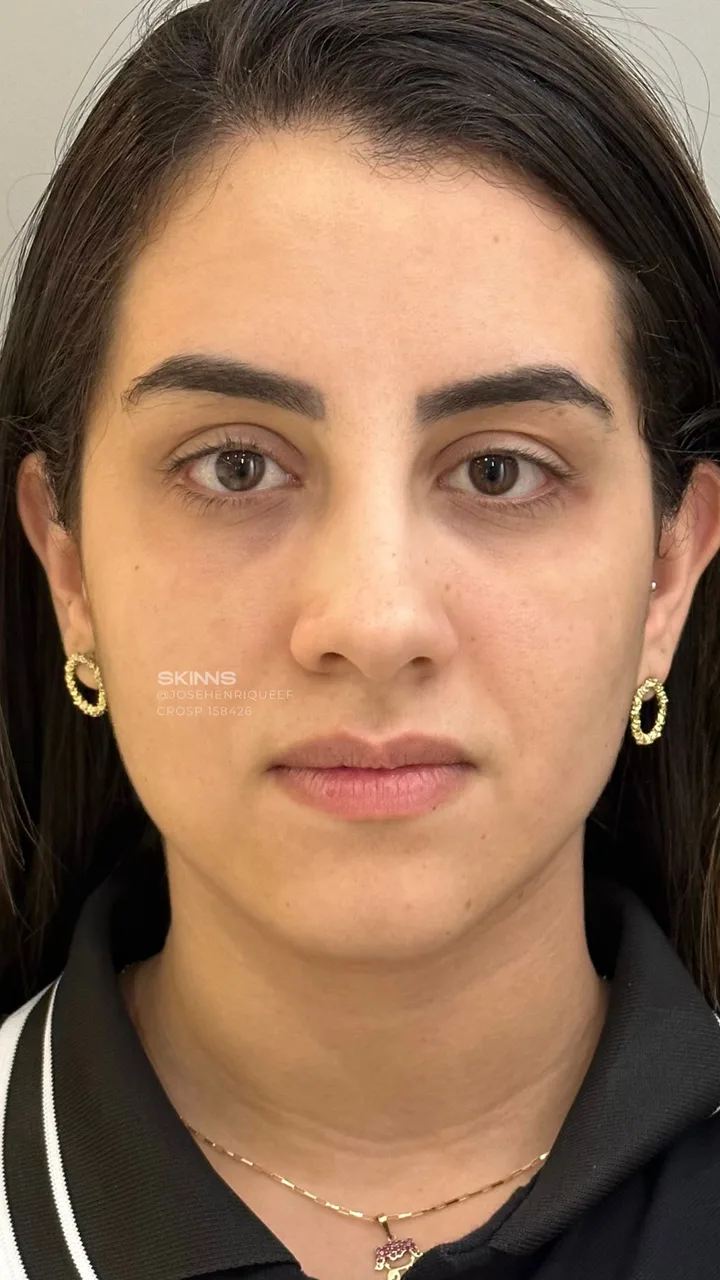 After — Blefaropeel