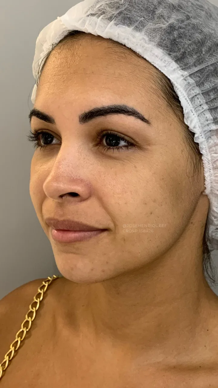 Antes — Preenchimentos Faciais