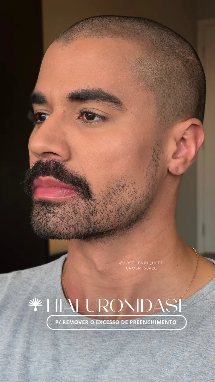 Después — Protocolo Reverse