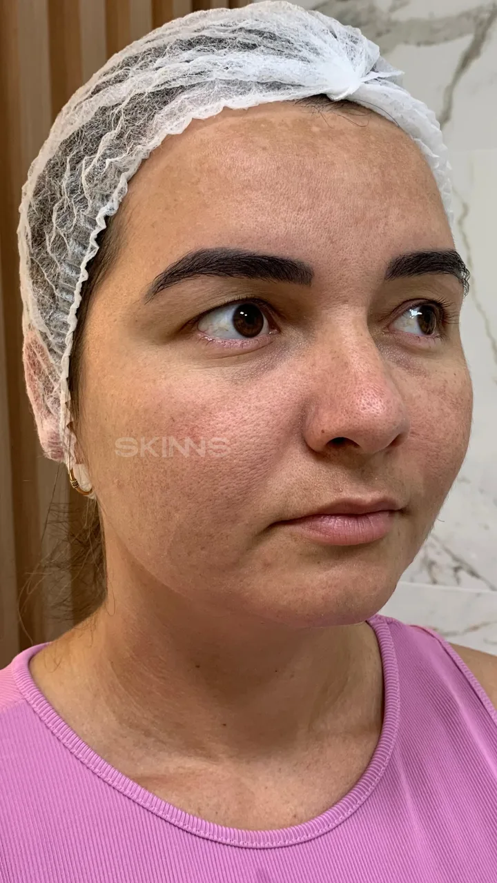 Antes — Skims Melani